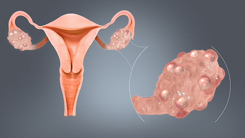Polycystic-Ovaries-மார்பகப் புற்றுநோய் -  அறிகுறிகள்,  தடுக்கும் வழிமுறைகள் (Breast Cancer Symptoms and Ways to reduce Breast Cancer risk)